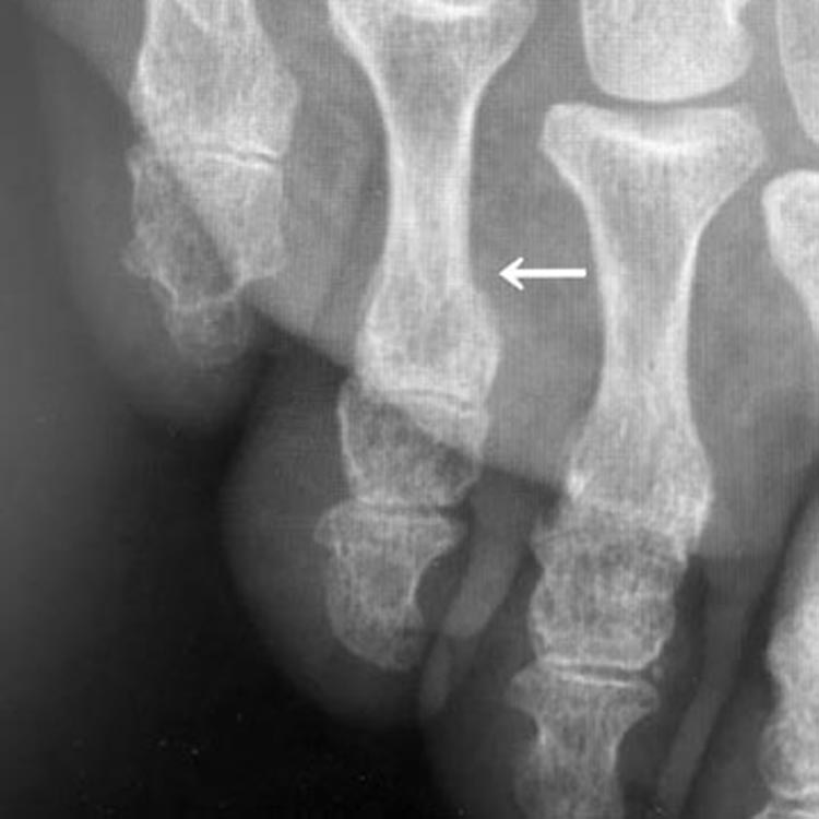 受傷直後のレントゲン写真