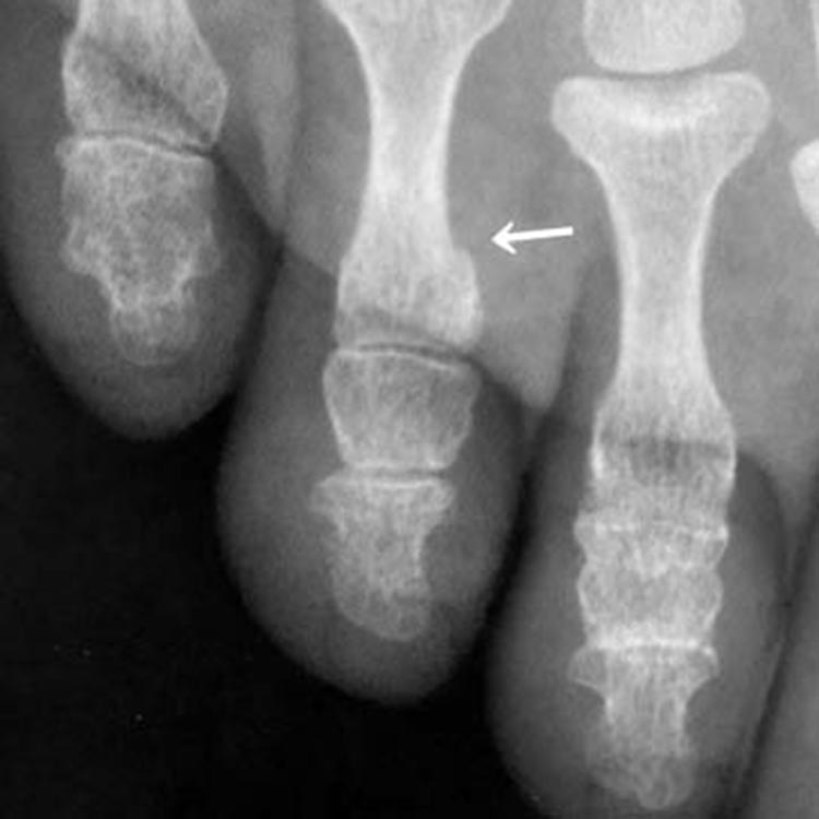 受傷1週後のレントゲン写真