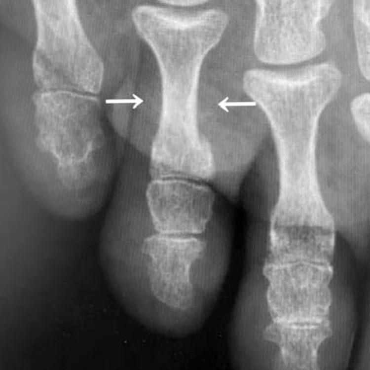 受傷2週後のレントゲン写真