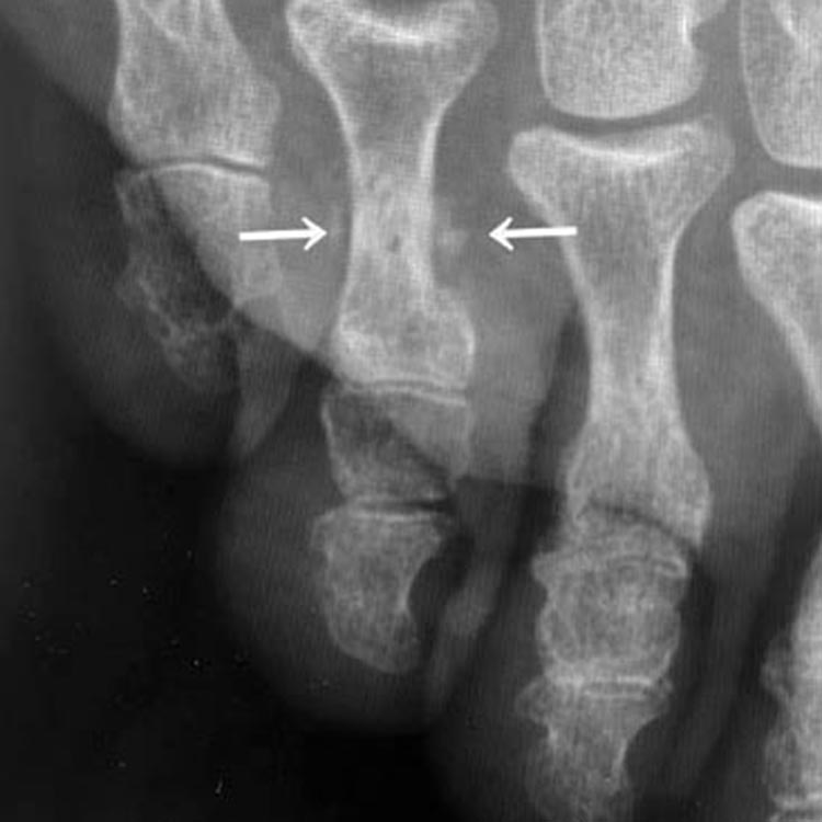 受傷3週後のレントゲン写真
