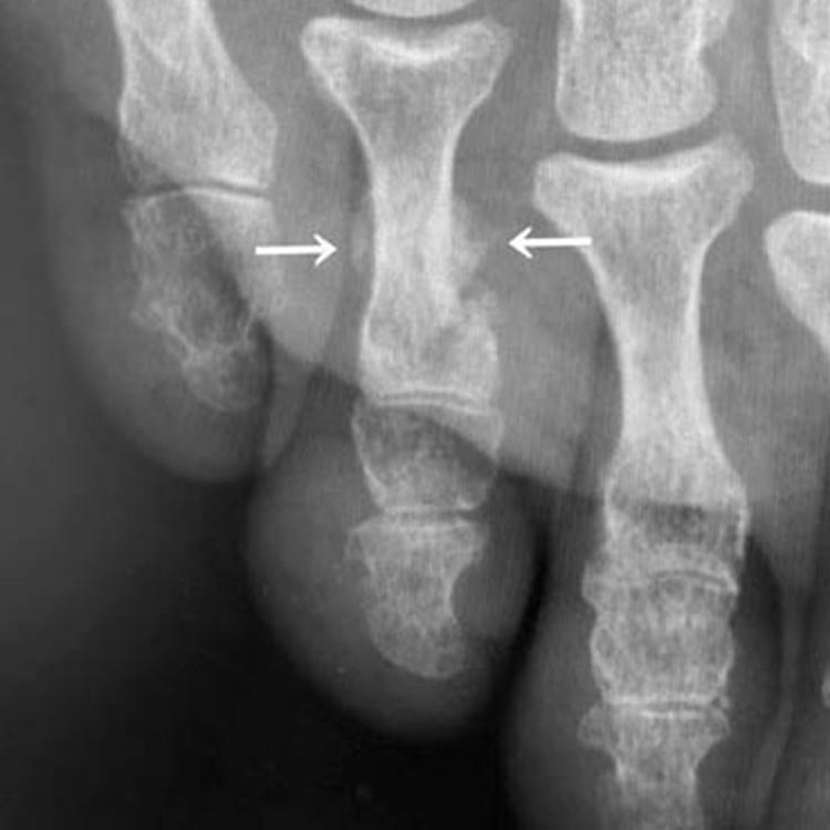 受傷4週後のレントゲン写真